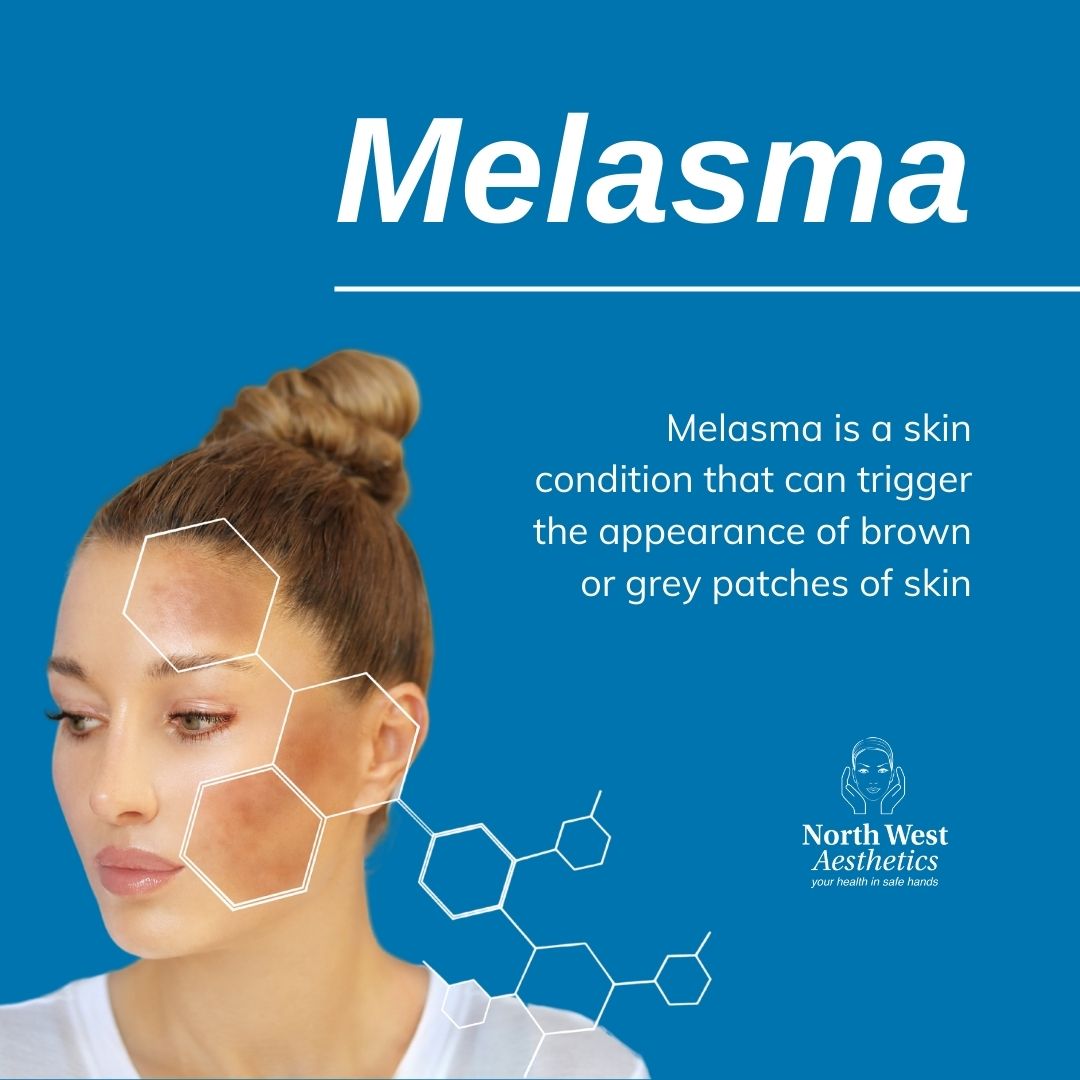 demt82's tweet photo. #Melasma is a condition that can trigger the appearance of brown or grey patches of #skin.

The cause is unknown but things like #sundamage are linked. To restore a more even skin tone, talk to a specialist about chemical peels and prescription #skincare - https://t.co/vbrNm0rd9T https://t.co/Qx18cTknrQ