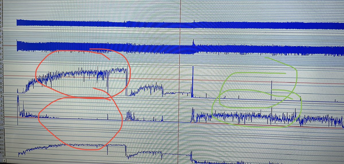 A good indirect sign for leaks : when the triggered cycles decrease and the control cycles (wrongly due to leaks (red circles) increase…decrease the triggered cycles is not always a good point!