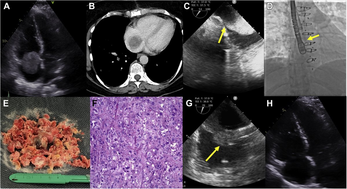 Case:  percutaneous debulking of a very large right atrial tumor

➡️ doi.org/10.1016/j.jsca…

#AngioVac @BassimElSabawi @AMohadjer_