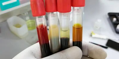 Just published our <a href="/Yale_LabMed/">Yale Lab Medicine</a> ‘s guide to dealing with #hemolysis #icterus and #lipemia. New approaches to dealing with old foes: clinicallab.com/hemolysis-icte… #PathTwitter #pathology #labmed <a href="/_AACC/">❃</a>
