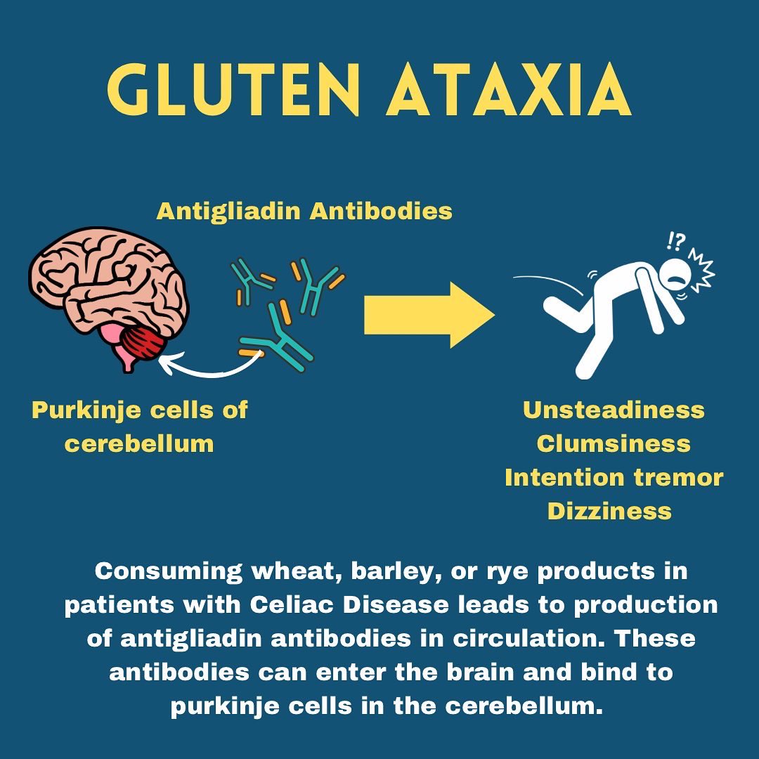 Keystoneneuro's tweet photo. Gluten ataxia: a rare cause of balance problems in patients with Celiac Disease https://t.co/20IsRSBkul