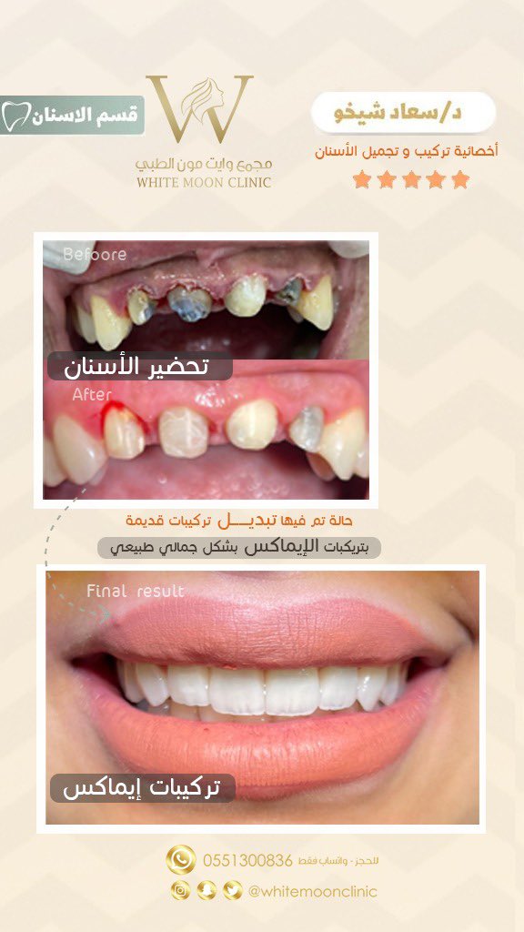 حالات قبل و بعد 
تركيبات اسنان 🦷✨
د.سعاد شيخو - اخصائية تركيب و تجميل الاسنان 

📍الطايف- البيعة - شارع الخمسين امام ممشى تيرا مول 

 #صباح_الخيرᅠ