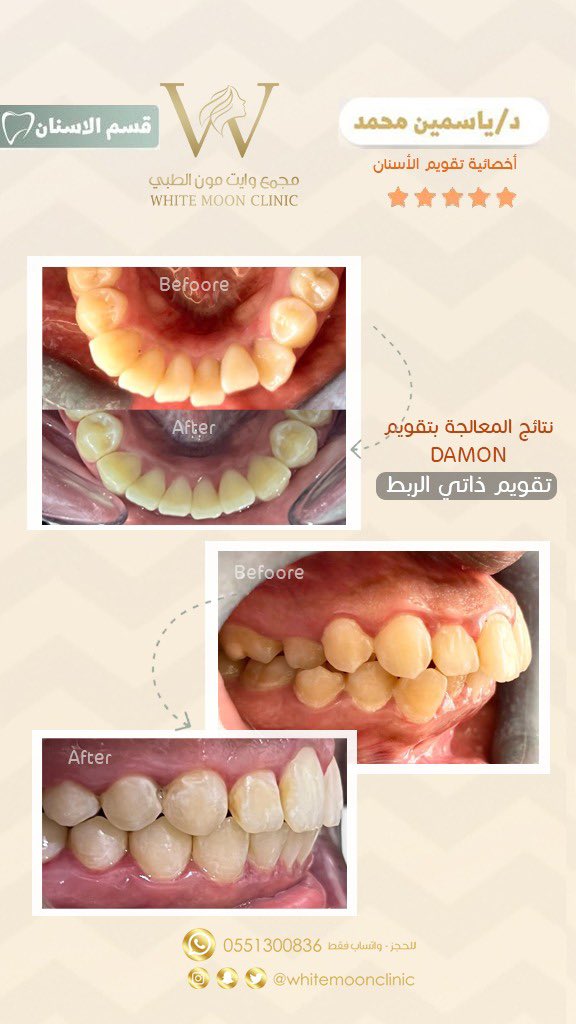 حالات قبل و بعد 
تقويم اسنان - ديمون  🦷✨
د.ياسمين محمد   - اخصائية تقويم الاسنان 

📍الطايف- البيعة - شارع الخمسين امام ممشى تيرا مول 

 #صباح_الخيرᅠ