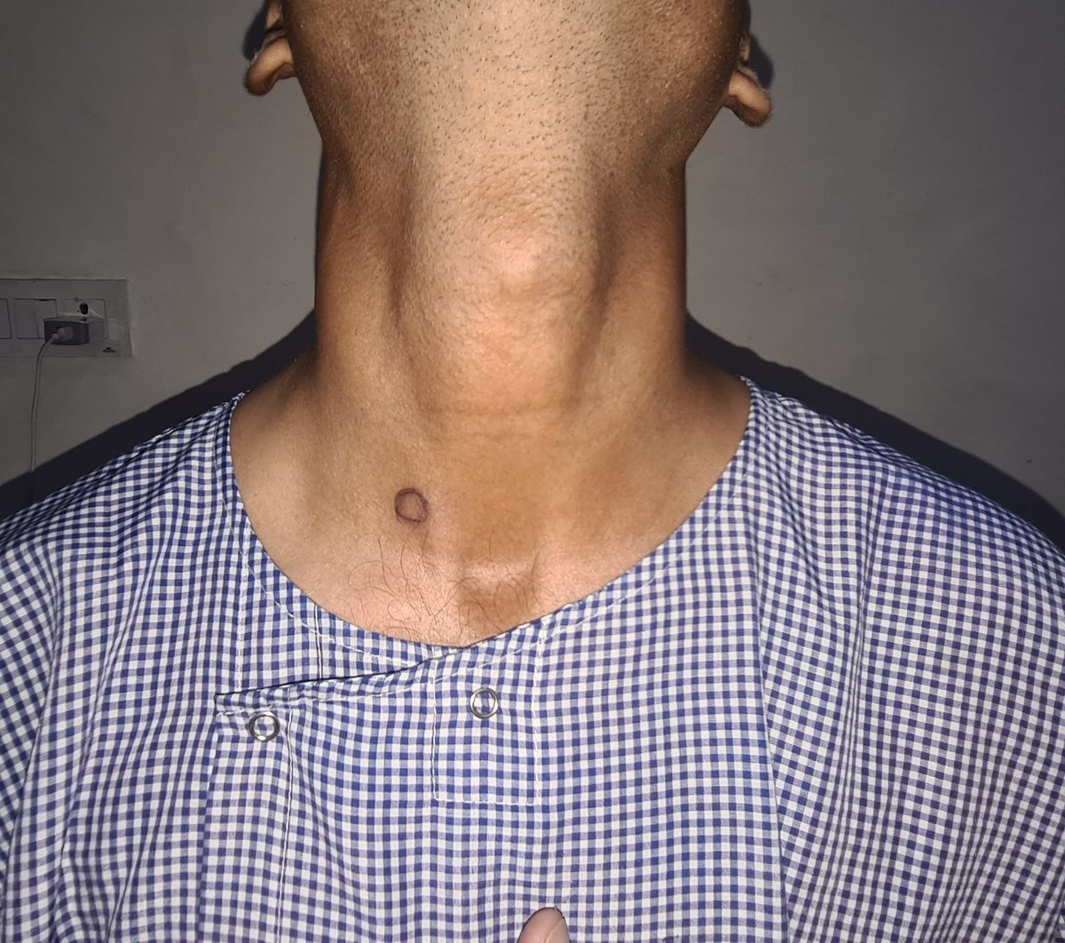 Simple hack to perform Minimally invasive Parathyroid surgery: 

Preoperative skin marking of adenoma by radiologist. Obviates the need to have ultrasound in operating theatre.
Works equally well!! 

#parathyroidsurgery @ParaTroupers1
#MedTwitter @IAESurgeons