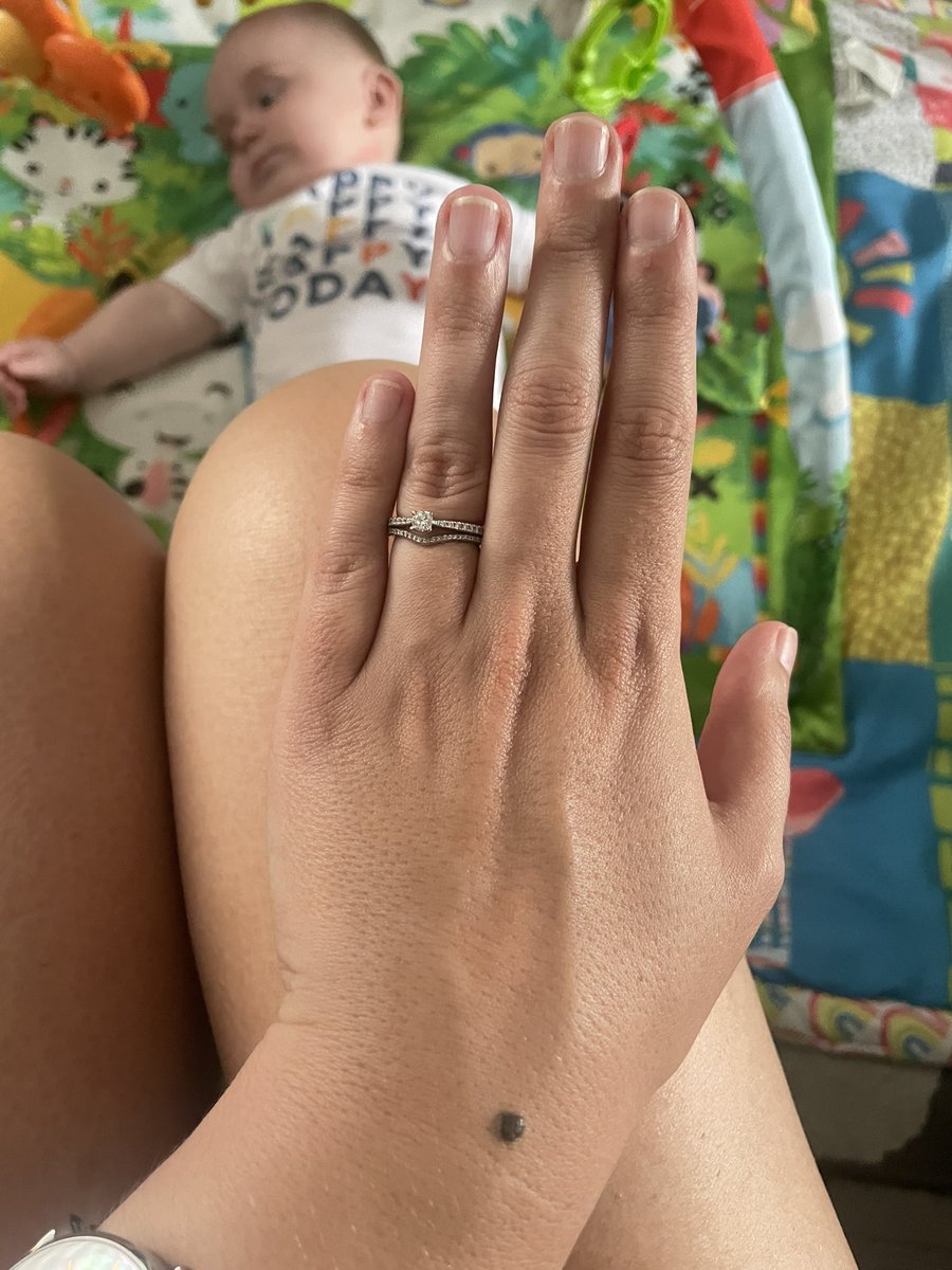 shivvybaby87's tweet photo. A short story in photos…get your moles checked, it might save your life. #checkyourmoles #thismorning #BeSkinSmart #molecheck https://t.co/RgMAHF1PpI