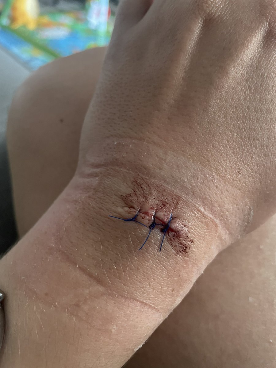 shivvybaby87's tweet photo. A short story in photos…get your moles checked, it might save your life. #checkyourmoles #thismorning #BeSkinSmart #molecheck https://t.co/RgMAHF1PpI