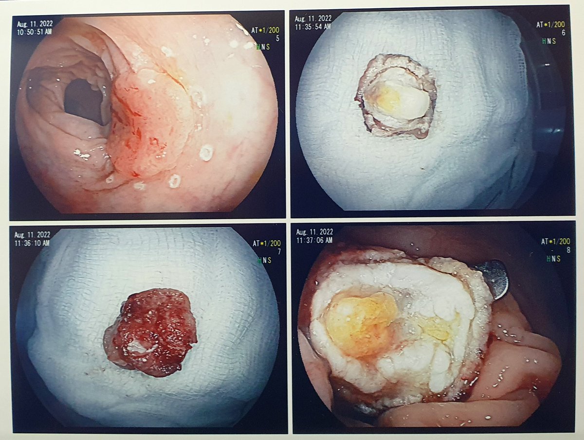 amckenzieMD's tweet photo. En el Servicio de Gastroenterología del CHDrAAM realizamos de forma ambulatoria la resección endoscópica de un adenocarcinoma de recto en una paciente no candidata a cirugía, utilizando por primera vez en Panamá el dispositivo de resección transmural OVESCO FTRD. https://t.co/J4mhE7Wp9P