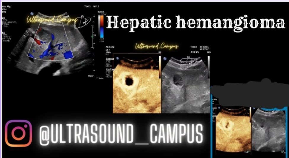 ultrasound_camp's tweet image. 🔑#CEUS: Following the intravenous administration of #SonoVue, the lesion shows peripheral, discontinuous nodular enhancement.
#Philipshealthcare #Philips @icus_society #contrastenhancedultrasound #ultrasound #medstudent #sonographer #FOAMRad #FOAMed