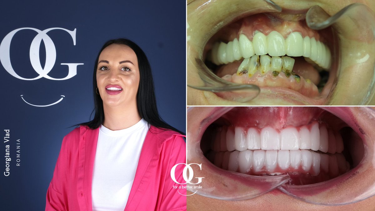 dtozanguner's tweet photo. ๐
๐๐๐๐๐๐๐๐! ๐คฉ๐
Georgiana visited us from the Romania. We made full mouth OG Smile for her! Smile forever Georgiana. Now it's your turn to get the perfect OG Smile!
WhatsApp / Viber
๐+491783233900
#ogsmile #dentist #dentalclinic #beforeandafter #smilemakeover https://t.co/s6zzqLZWb4