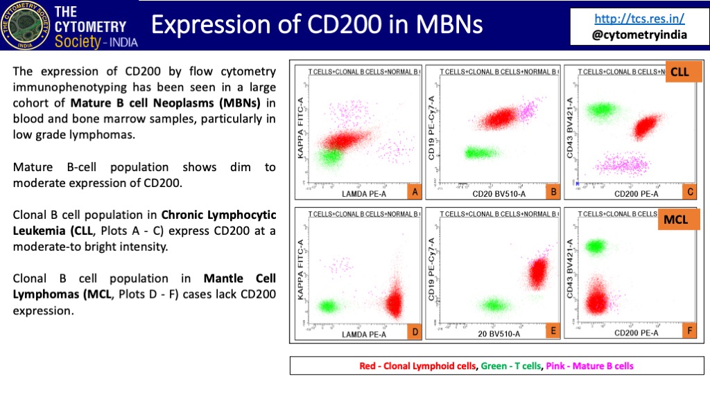 CytometryIndia's tweet photo. CD200 has proved to be a sensitive marker for the discrimination of CLL from MCL during immunophenotyping of CD19/CD5 co-expressing tumours. The absence of CD200 expression virtually rules out CLL. #TCSTuesday #flowbot #flowcytometry #pathtwitter @ICCS_Education @EsccaOfficial https://t.co/5a7IN02Aah
