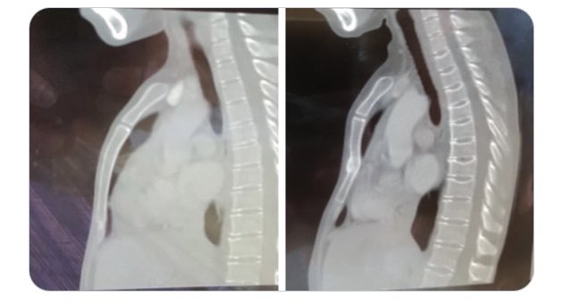 Resus2Runner's tweet photo. My body has been through too much.
My #DNACPR #ReSPECT form & #AdvancedDirective are not a wish to die, but one to not suffer.
How doctors still ask me if I really don’t want “just one cycle of CPR” baffles me!
#bowelcancer #CPR @AGoodDeath https://t.co/Lkgoivc7hI