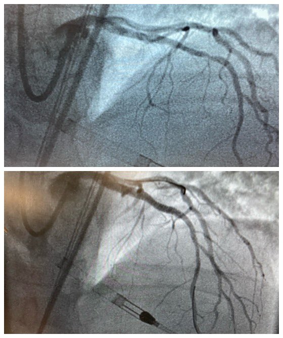 kevincantrelle's tweet photo. @ProtectedPCI by @KP_CardioDoc @RapidesRegional on patient with LV dysfunction, turned down for CABG.  ImPella allowed for image guided #completerevascularization w/orbital atherectomy &amp; multiple DES #smalltownCardiology #BigcityMedicine https://t.co/44l9p7iHcH