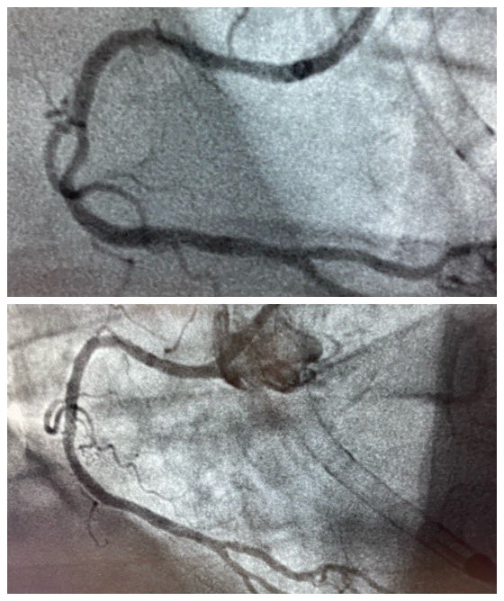 kevincantrelle's tweet photo. @ProtectedPCI by @KP_CardioDoc @RapidesRegional on patient with LV dysfunction, turned down for CABG.  ImPella allowed for image guided #completerevascularization w/orbital atherectomy &amp; multiple DES #smalltownCardiology #BigcityMedicine https://t.co/44l9p7iHcH