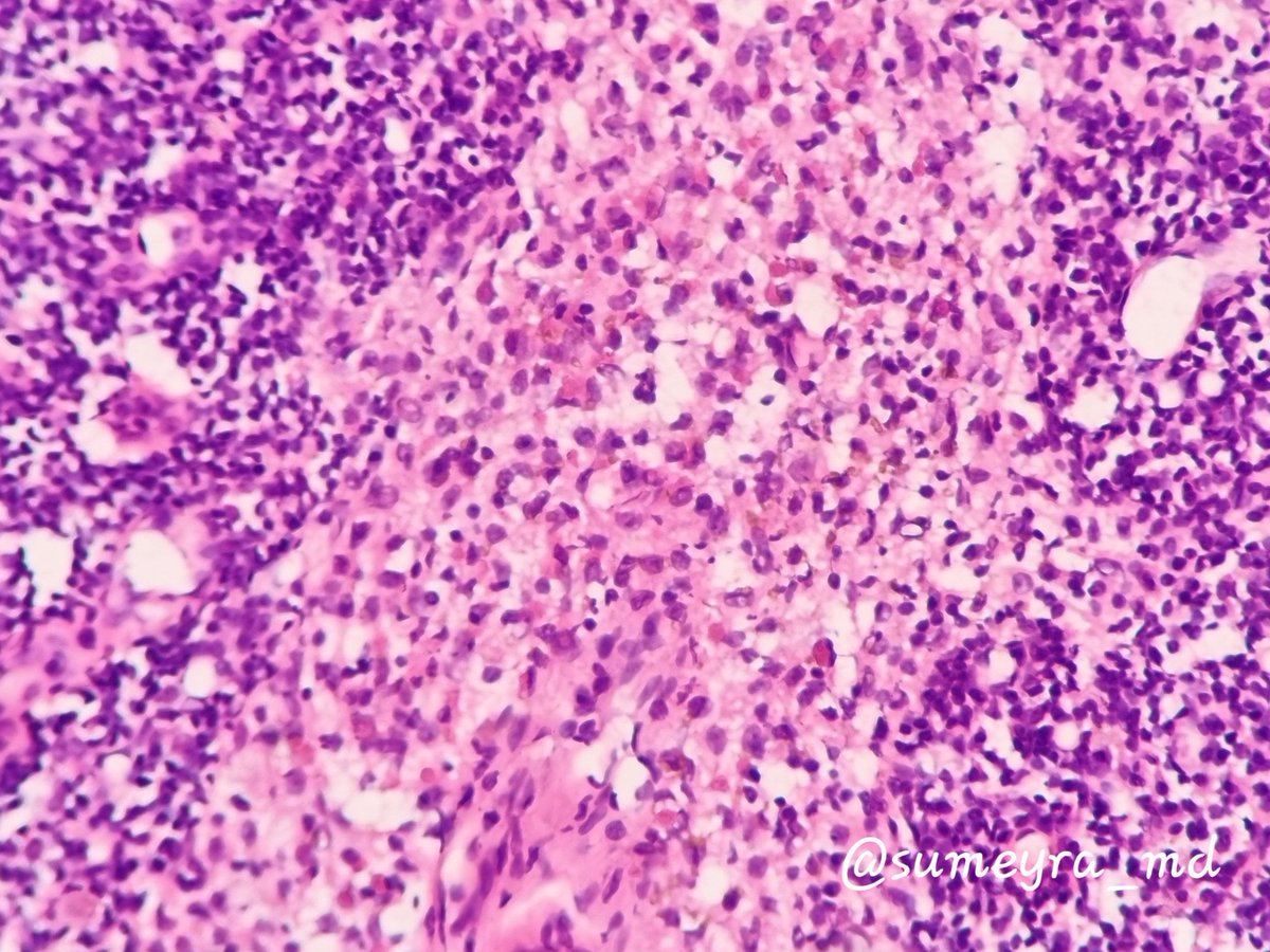 sumeyra_md's tweet photo. One of my worst nightmares😵‍💫
Frozen sections and ongoing slides from axillary sentinel lymph node biopsy🔬metastatic invasive lobuler carcinoma 😱 #PathTwitter #breastpath https://t.co/HVsiXmMjMA https://t.co/l36199VK0k