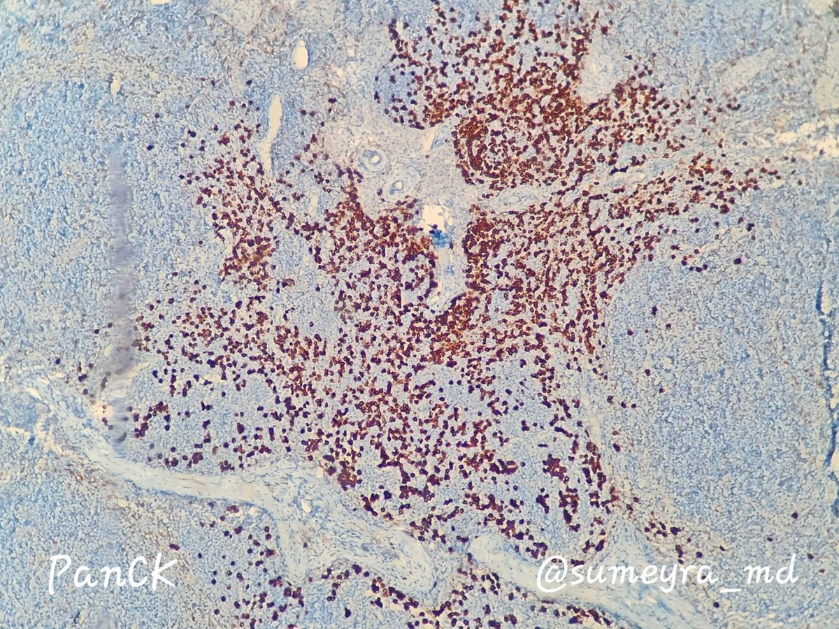 sumeyra_md's tweet photo. One of my worst nightmares😵‍💫
Frozen sections and ongoing slides from axillary sentinel lymph node biopsy🔬metastatic invasive lobuler carcinoma 😱 #PathTwitter #breastpath https://t.co/HVsiXmMjMA https://t.co/l36199VK0k