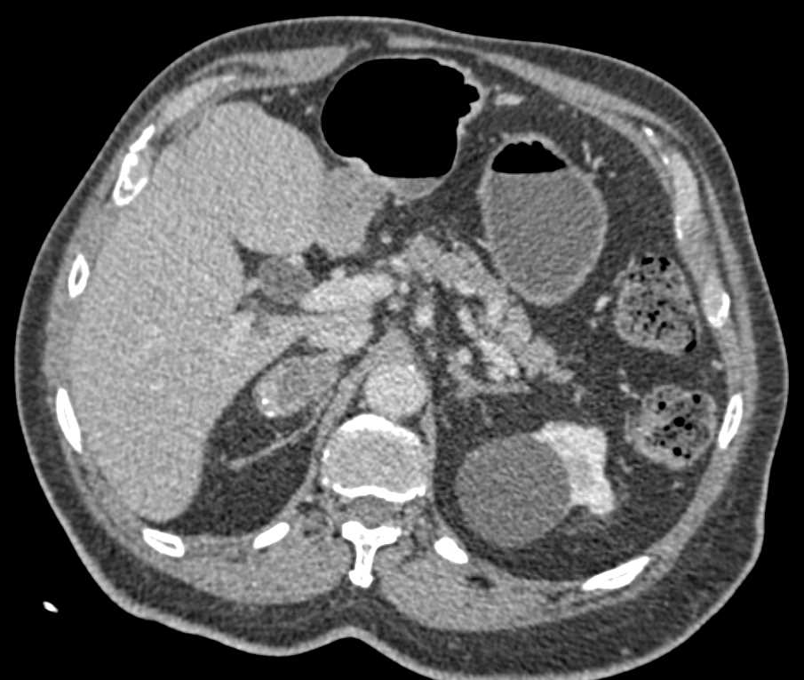 Elliot K Fishman / CTisus.com tweet media