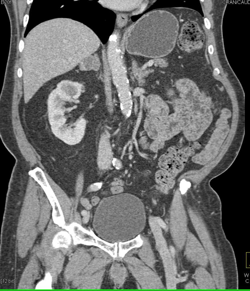 Elliot K Fishman / CTisus.com tweet media