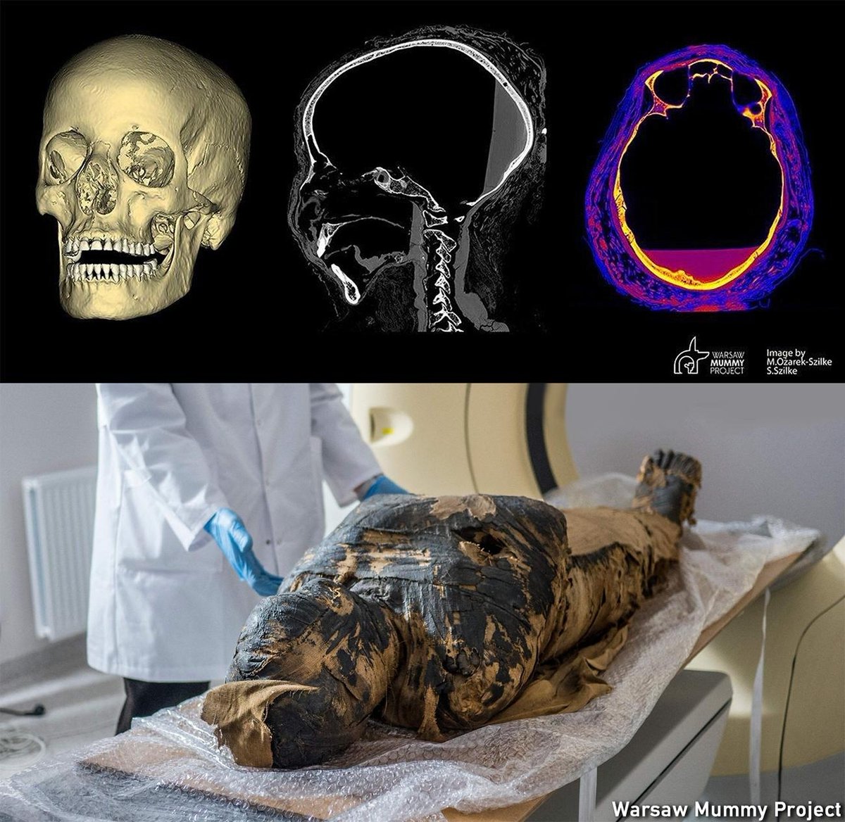 Mummy of the Mysterious Lady may have died of cancer

A team of researchers with the Warsaw Mummy Project, has announced on their webpage that a #mummy in their collection that has come to be known as the Mysterious Lady may have had #nasopharyngealcancer.