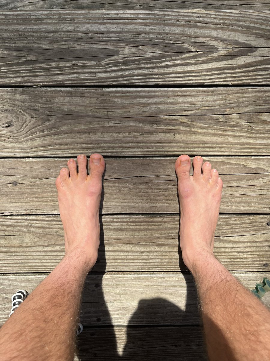 BowTiedFighter's tweet photo. So you want strong feet huh?

I know a thing or 2 about that😈

When I transitioned from wrestling to BJJ the first thing I noticed was how badly my feet hurt grappling barefoot 

Something had to be fixed, so I got to work

Now my feet strong, my toes are spread‼️

Lets learn
🧵 https://t.co/PFFKZl9Nfg