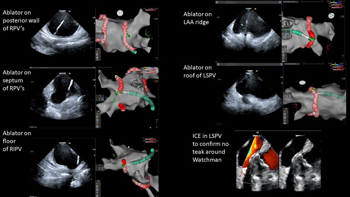 Dr_Mehrotra_EP's tweet photo. Needed to use ICE in LA today to confirm no leak around Watchman due to questionable TEE images. Ended up using it for PVI and got some great pictures. Thanks to @deshazo_eric @BiosenseWebster. #EPeeps #icefirst https://t.co/Ls69VaDUxF