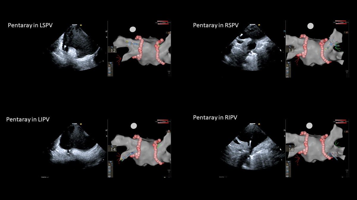 Dr_Mehrotra_EP's tweet photo. Needed to use ICE in LA today to confirm no leak around Watchman due to questionable TEE images. Ended up using it for PVI and got some great pictures. Thanks to @deshazo_eric @BiosenseWebster. #EPeeps #icefirst https://t.co/Ls69VaDUxF