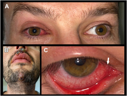 Case of conjunctivitis associated with #monkeypox virus (PCR positive conjunctival swabs). This raises the possibility of transmission via contact during eye exams. Healthcare professionals should be aware of this and employ adequate protection. ow.ly/ccMV50KkR4y