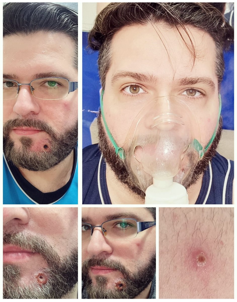 marciopannunzio's tweet photo. // ALERTA // Nestas últimas 3 semanas, vivi as dores e incertezas da Nova #Varíola, a #Monkeypox. Após alguns dias de febre, calafrios, fraqueza, dores de cabeça e nas articulações, tive inchaço nos gânglios,  bastante inflamação na garganta e uma afta bem dolorida. [+] https://t.co/R54FnbtoaU