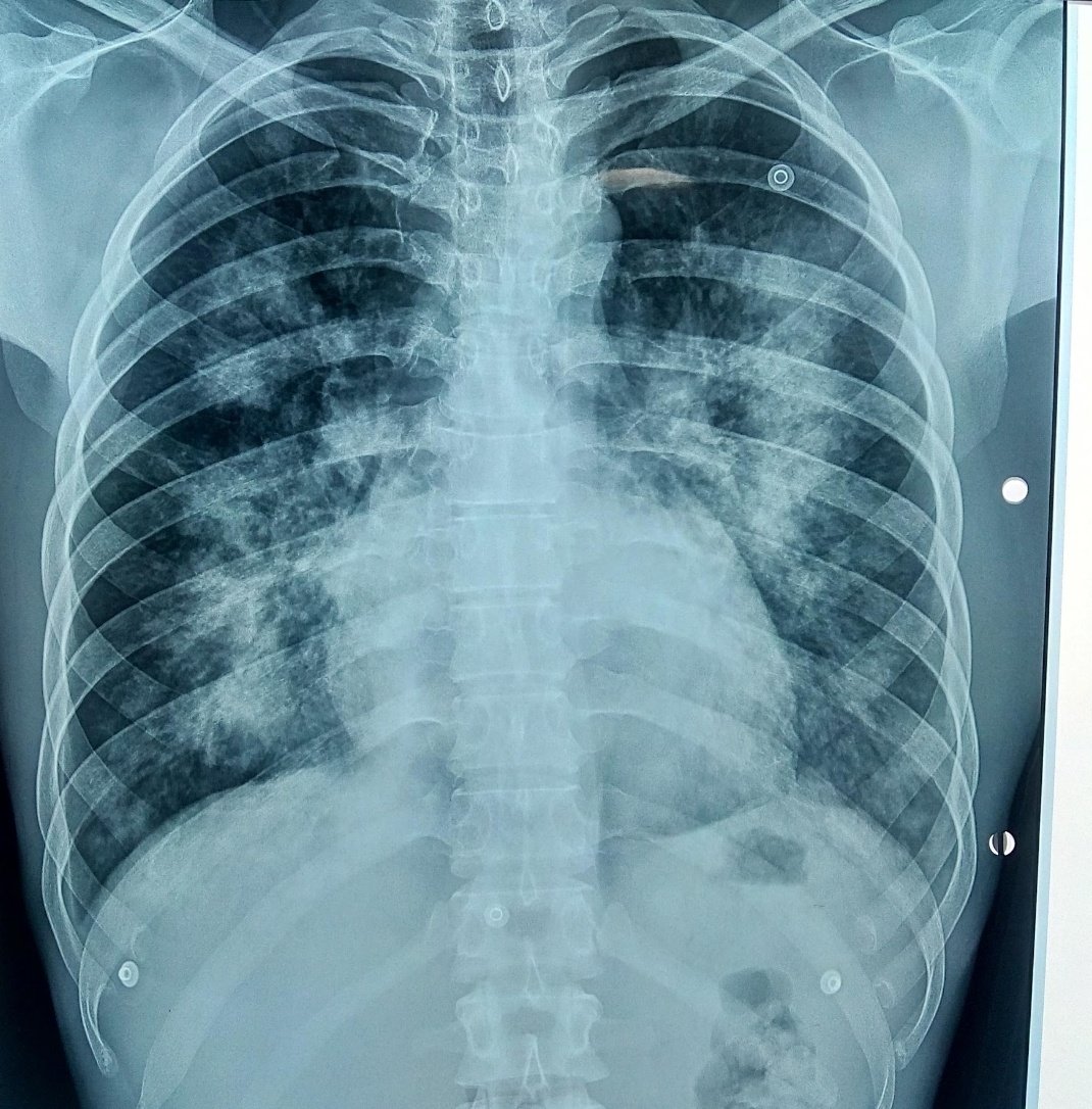 Mending_Kidneys's tweet photo. Meet the 🦇.
Young male with chronic glomerulonephritis with pulmonary edema.
Bat Wing Apperance
#nephrology 
#NephTwitter 
#Nephpearls https://t.co/mQ8xc38IcA