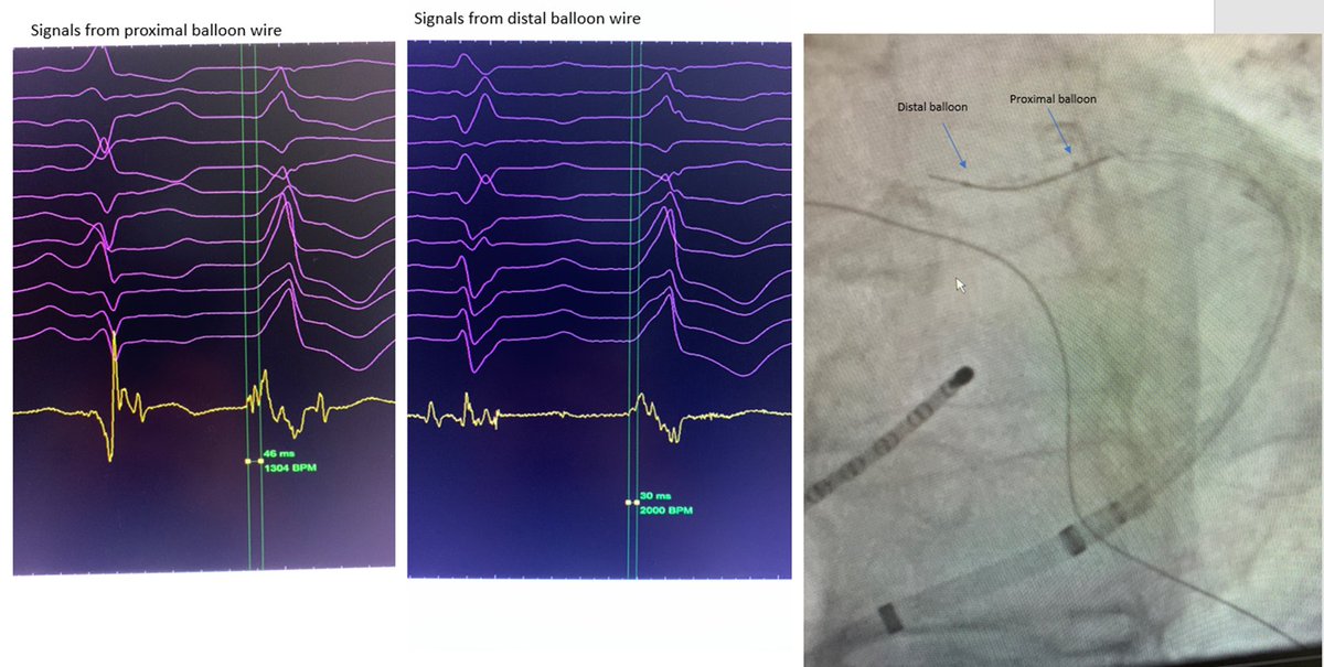 Fatima Ali-Ahmed (@fatimaaliahmed8) on Twitter photo Double balloon ETOH ablation LV summit PVC. Small CS veins mapped w/angioplasty wire. We inserted a needle in the pt's thigh for reference electrode. PVC bracketed in S1 branch with proximal and distal wire.
<a href="/alhsheikh/">Ali Sheikh</a> <a href="/SampathGundaEP/">Sampath Gunda</a> #EPeeps Thank you to our teachers! Double balloon ETOH ablation LV summit PVC. Small CS veins mapped w/angioplasty wire. We inserted a needle in the pt's thigh for reference electrode. PVC bracketed in S1 branch with proximal and distal wire.
<a href="/alhsheikh/">Ali Sheikh</a> <a href="/SampathGundaEP/">Sampath Gunda</a> #EPeeps Thank you to our teachers!