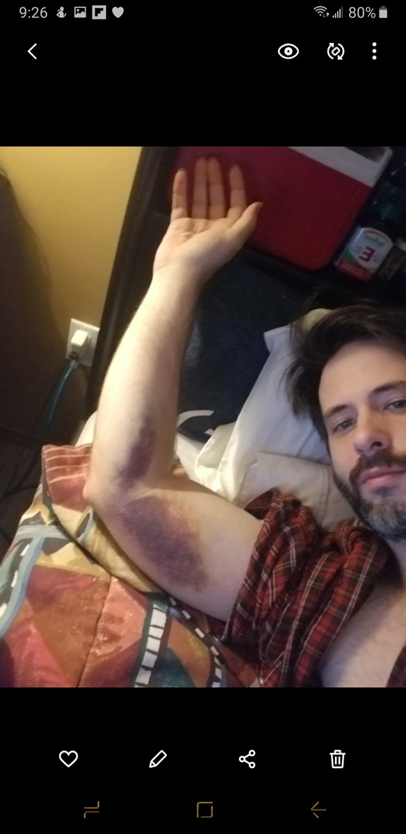 BlueSlots's tweet photo. I remember showing the doctor at  Emergency this bruise and he said it was nothing. https://t.co/ecYe8NQthK