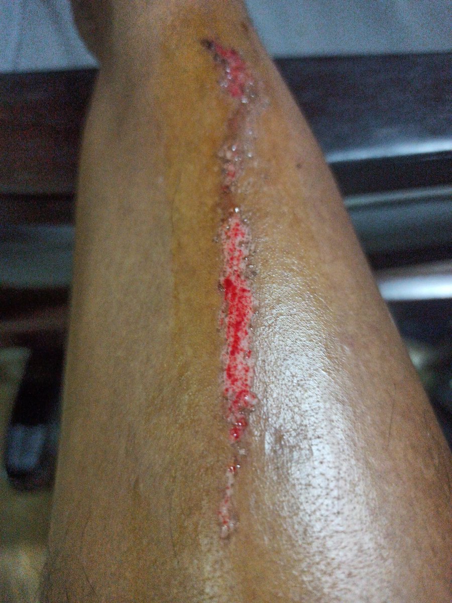 runner2274's tweet image. Now that gon' leave a mark ... Stupid cinderblock! Well, better this than a head-on collision with a moped ..