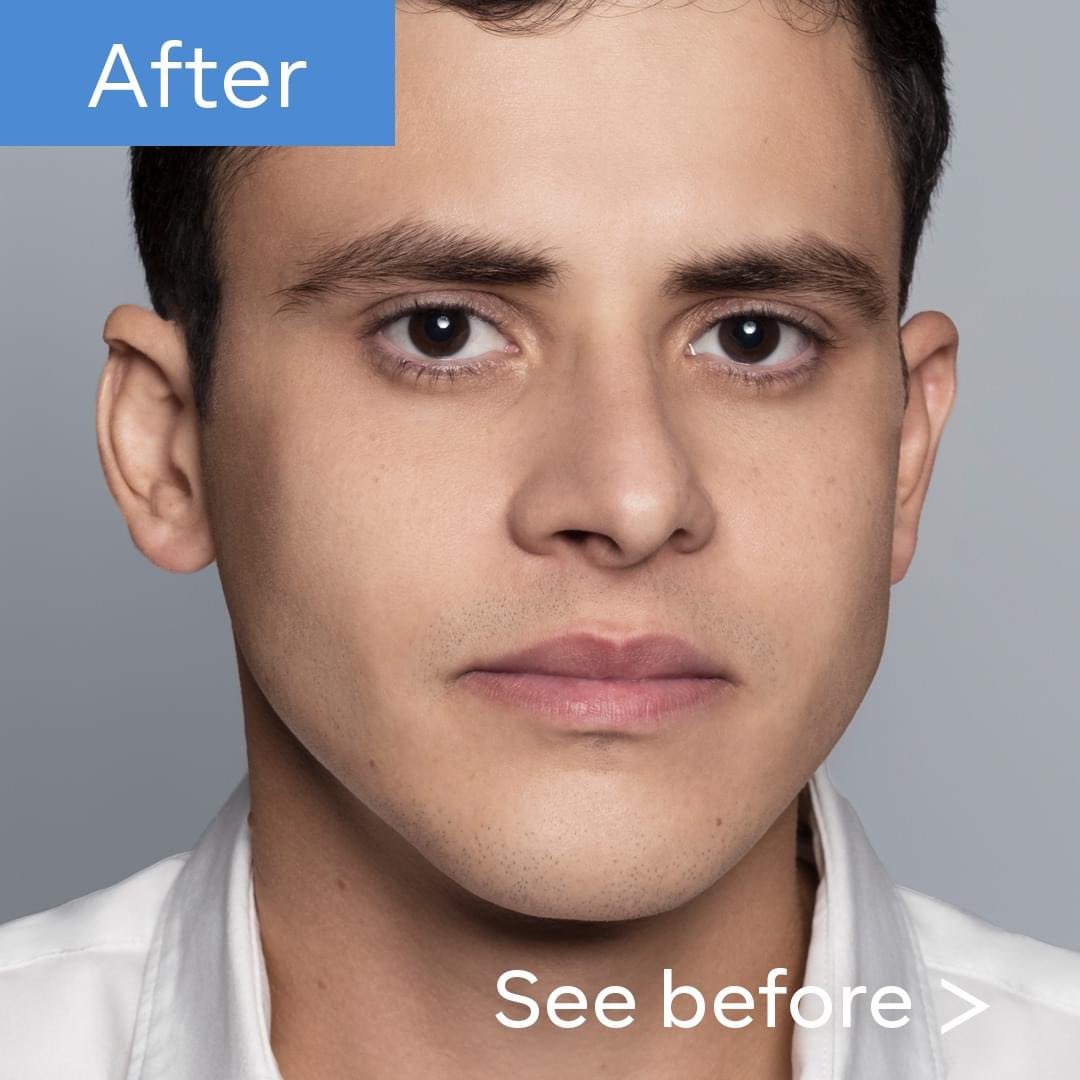 abmmedical's tweet photo. #Restylanedefyne Restylane Defyne you can define your chin and men you can have that whisked chin look https://t.co/fYIXfjsyk2 (818) 222-8042 https://t.co/6fdflhyQXx