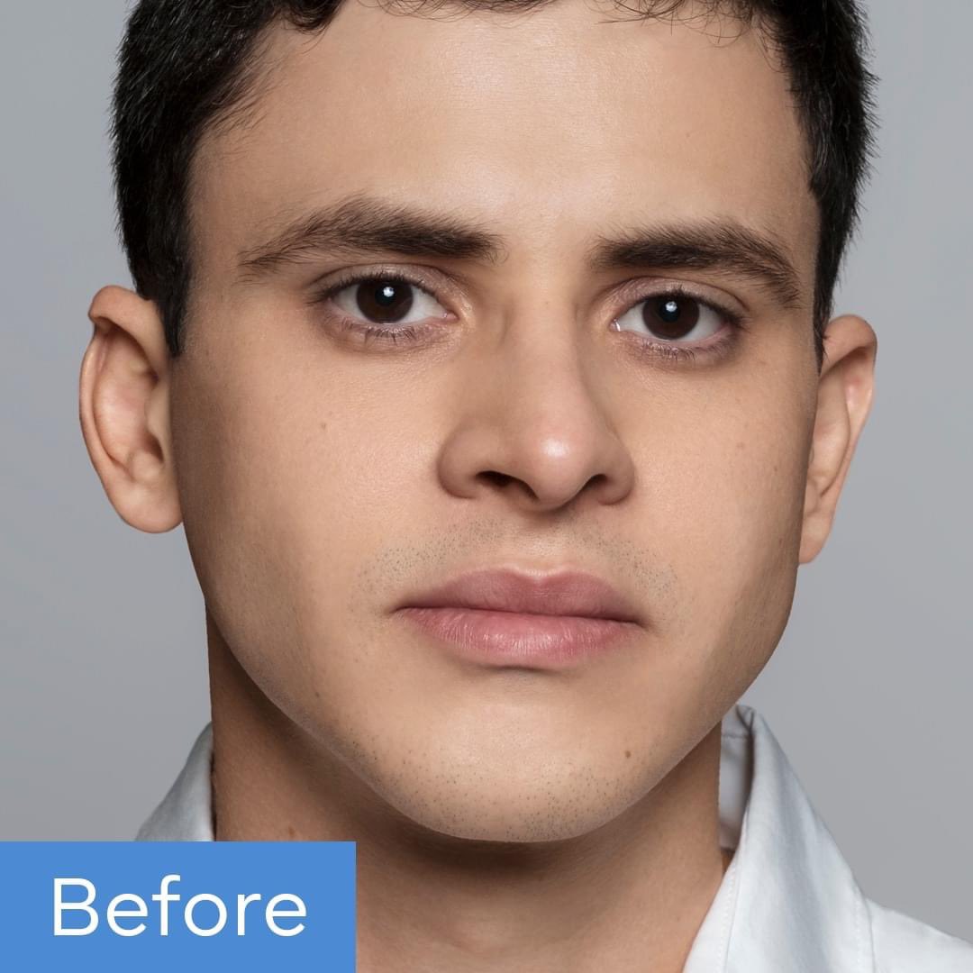 abmmedical's tweet photo. #Restylanedefyne Restylane Defyne you can define your chin and men you can have that whisked chin look https://t.co/fYIXfjsyk2 (818) 222-8042 https://t.co/6fdflhyQXx