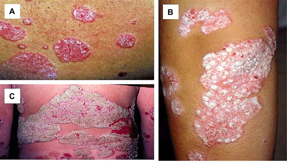 AADmember's tweet photo. The @US_FDA approved the PDE-4 inhibitor roflumilast cream 0.3% for the treatment of #plaquepsoriasis in individuals aged 12 and older. Learn more in #DermWorldWeekly https://t.co/jgdJDxX8SZ #dermtwitter https://t.co/XFtzzqTwS3