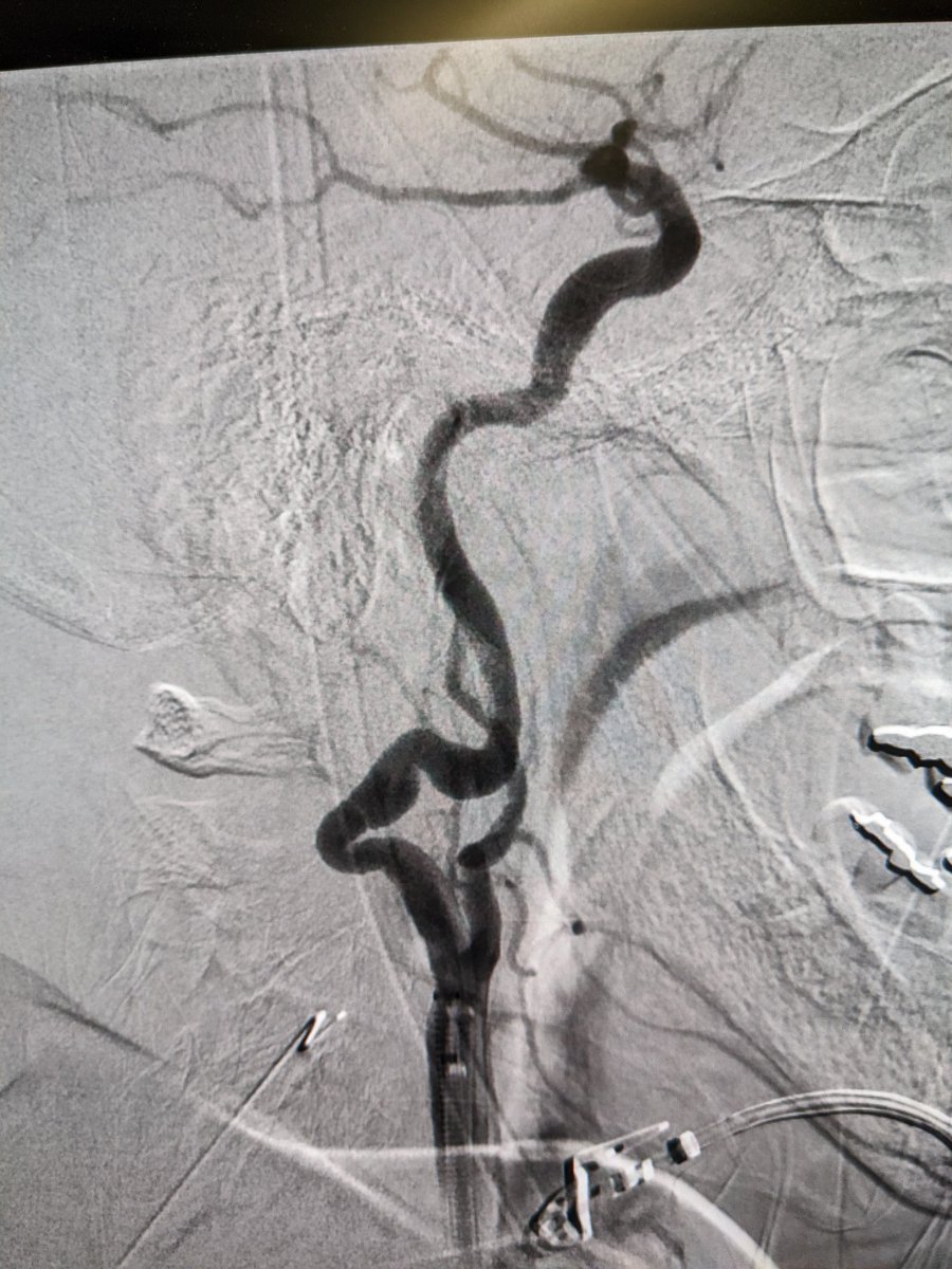 Happy to be at the first site in the world to use this Canadian-made new stroke platform.  Early impressions - Handles tough curves like a champ and, despite the navigability, works well with stentrievers.  More experience/study now needed.  <a href="/LHSCCanada/">London Health Sciences Centre</a> <a href="/vena_medical/">Vena Medical</a>