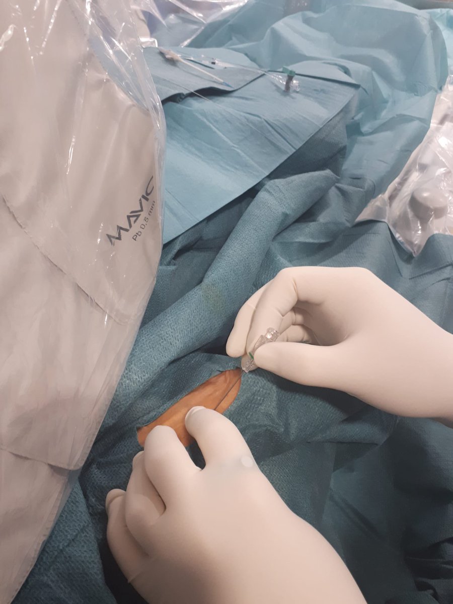 VirTauli's tweet photo. Actualmente, el acceso radial está en pleno auge en radiología intervencionista y neurointervencionismo. Esto es debido a la baja incidencia complicaciones relacionadas con el acceso vascular, la reducción de estancia hospitalaria, la movilización precoz y el confort del usuario https://t.co/1i9jMxOJAf