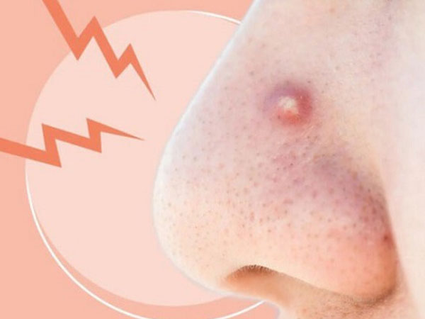 thanhhaiclinic's tweet photo. 6 cách trị mụn bọc ở mũi sau 1 đêm từ chuyên gia
https://t.co/2Xu3KaUgu3
#thanhhai #HDDerma #phikimdieutrimun #trimun https://t.co/rxoxDInnKR