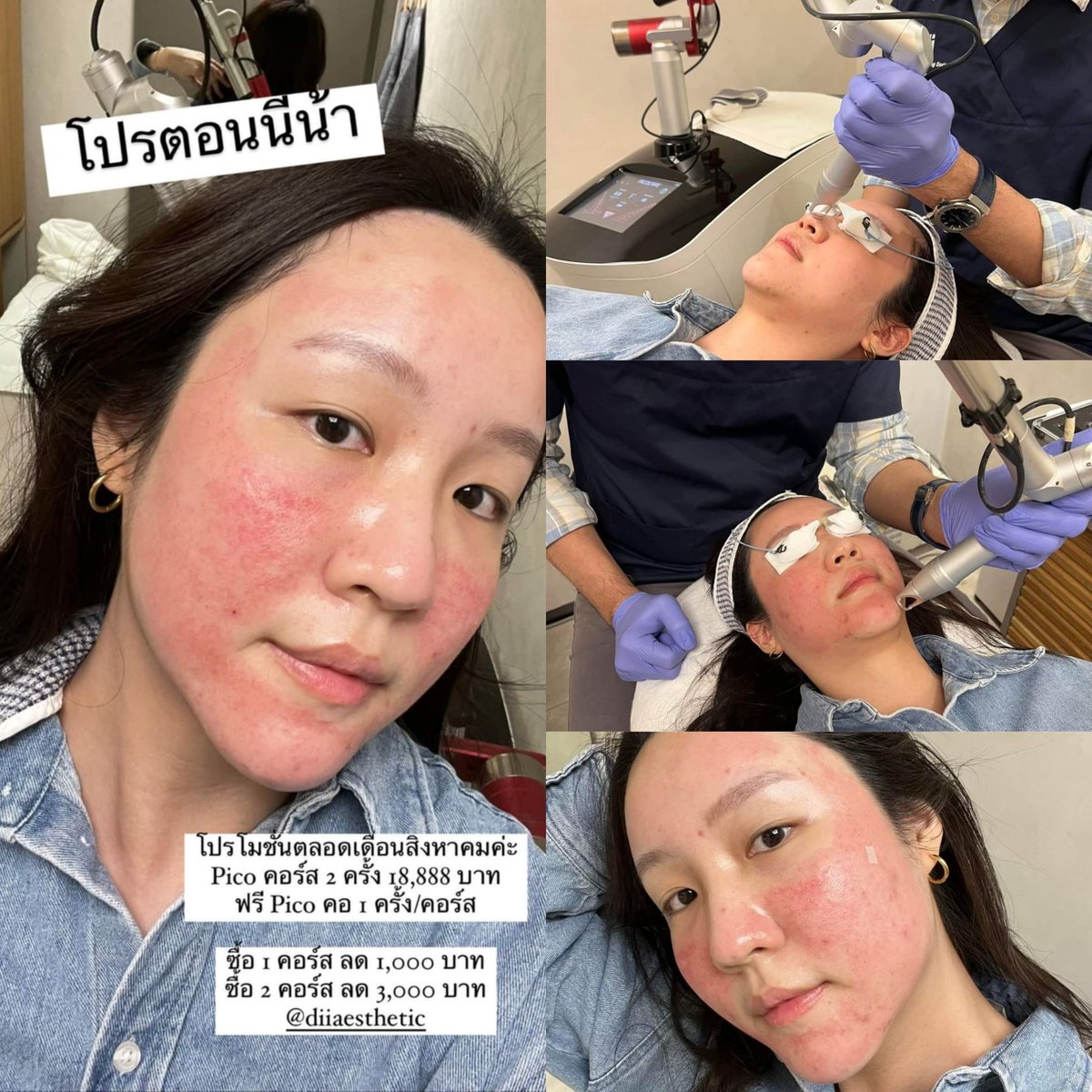 Ployzpim's tweet photo. #Repostcredit @Khwanvasinee
ไปทำ pico care รอบที่2มาแล้ววว
รอบแรก อ่านรีวิวได้ที่ #kkxdiiaesthetic ✨✌🏻
#diiaesthetic #รีวิวpico #pico #picocare #picolaser #laser #reviewpico #beauty #รอยสิว #ใช้ดีบอกต่อ #howtoperfect #howtobeauty https://t.co/tFUmpUk0wG