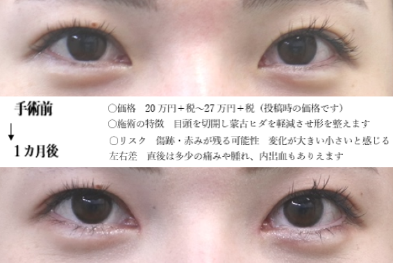 drmatsui's tweet photo. わかりにくい写真かもしれません。
形のぱっと見の変化は小さいのですが、奥目感を減らした例です。
実際に会うとけっこう違いは大きいです。
＃目頭切開 https://t.co/QzECtoOFIb
