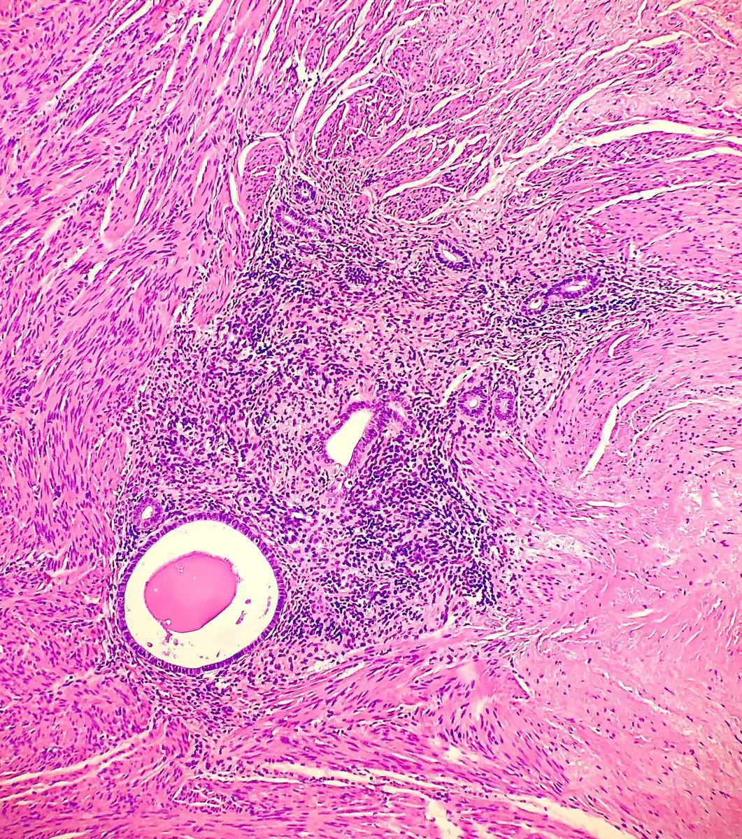 Partial colon resection revealing an incidental finding. What is the diagnosis? Answer: kikoxp.com/posts/14159 #PathArt #PathTwitter #MedTwitter