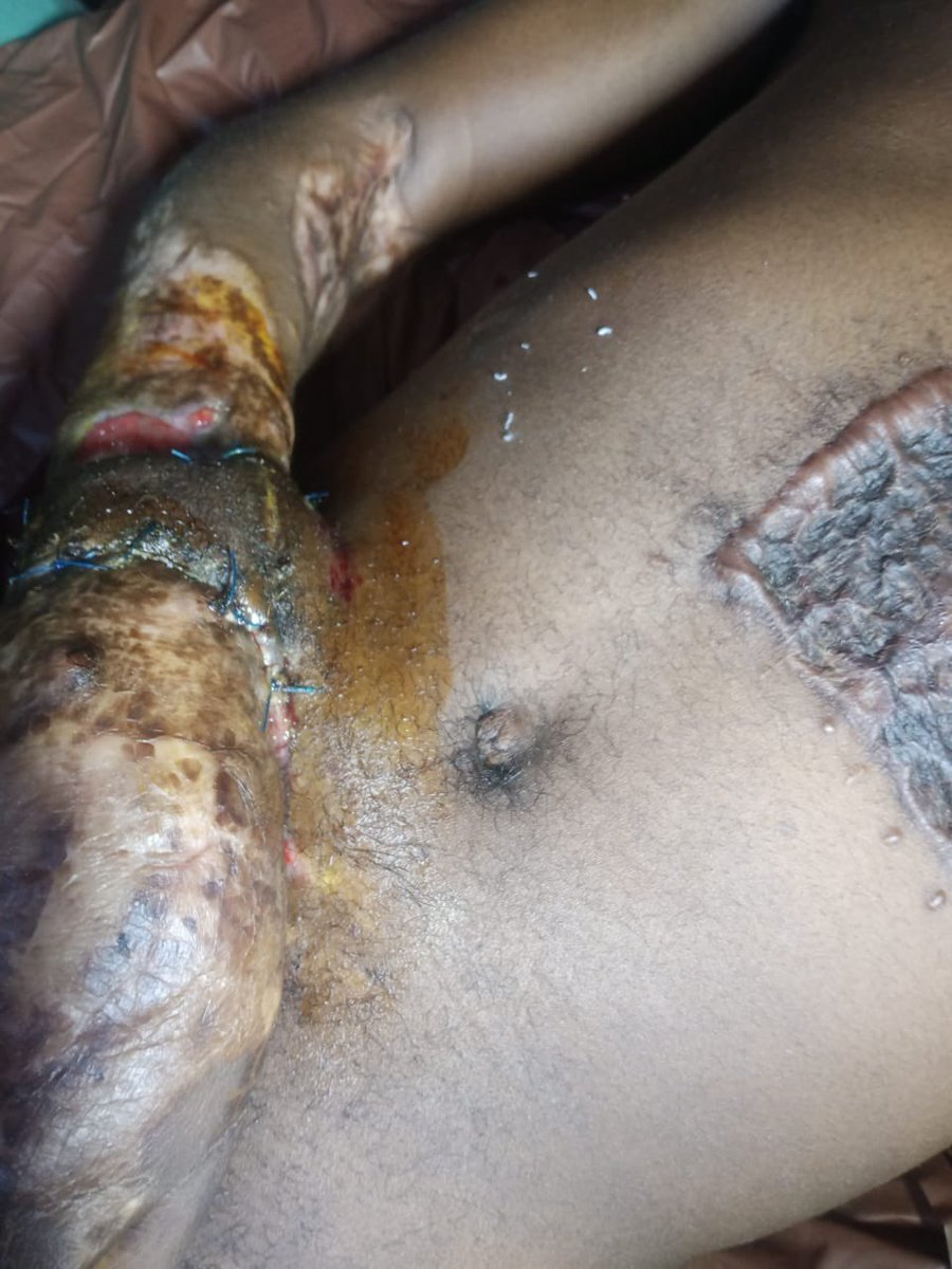 taiwoalabiho2's tweet photo. This is Jimoh Sadiq, an electrician who was working at the Olaiya Bridge that was recently commissioned in Osogbo. Apparently, he got electrocuted on a high tension cable at the bridge site on 5th of August 2021. Now he needs N3.5Million for surgery. #HelpSaveJimohSodiqFromBurns https://t.co/mn9fLgLOEt
