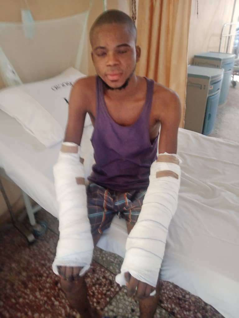 taiwoalabiho2's tweet photo. This is Jimoh Sadiq, an electrician who was working at the Olaiya Bridge that was recently commissioned in Osogbo. Apparently, he got electrocuted on a high tension cable at the bridge site on 5th of August 2021. Now he needs N3.5Million for surgery. #HelpSaveJimohSodiqFromBurns https://t.co/mn9fLgLOEt