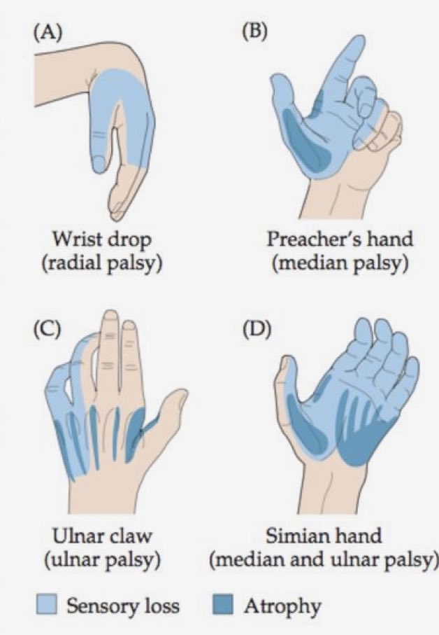 OGdukeneurosurg's tweet photo. Know your common peripheral nerve presentations. https://t.co/PRqeOJm5up