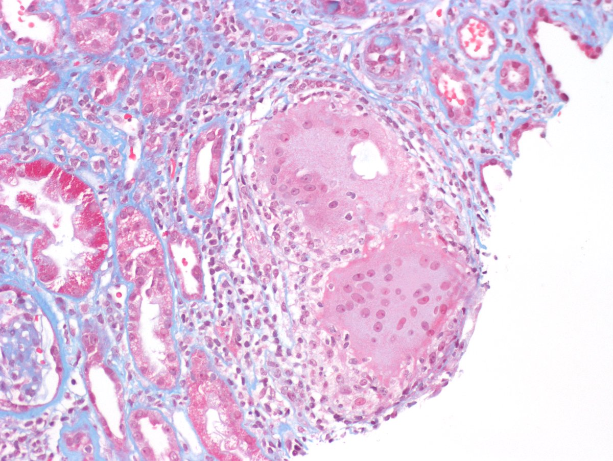 Nice example of sarcoidosis in kidney bx. Numerous well-formed non-caseating granulomas. Many multinucleated giant cells and some have calcifications. #RenalPath