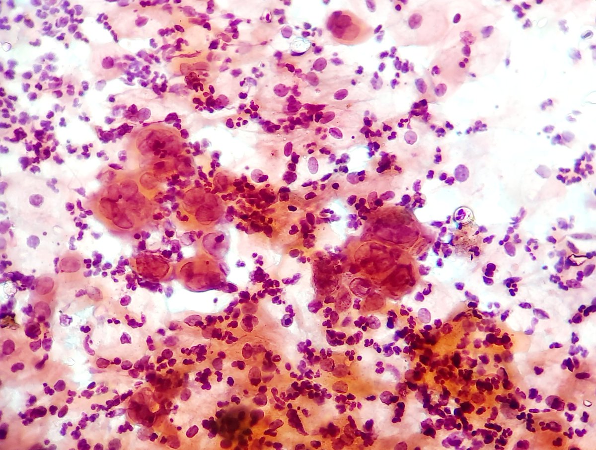 anitajawalgi's tweet photo. Sharing beautiful case of cervical pap smear. What is your diagnosis
Case borrowed from my colleague.
#PathTwitter #pathfinder #pathologists #pathlogy residents # #gynpath https://t.co/2XJYw9UmeC