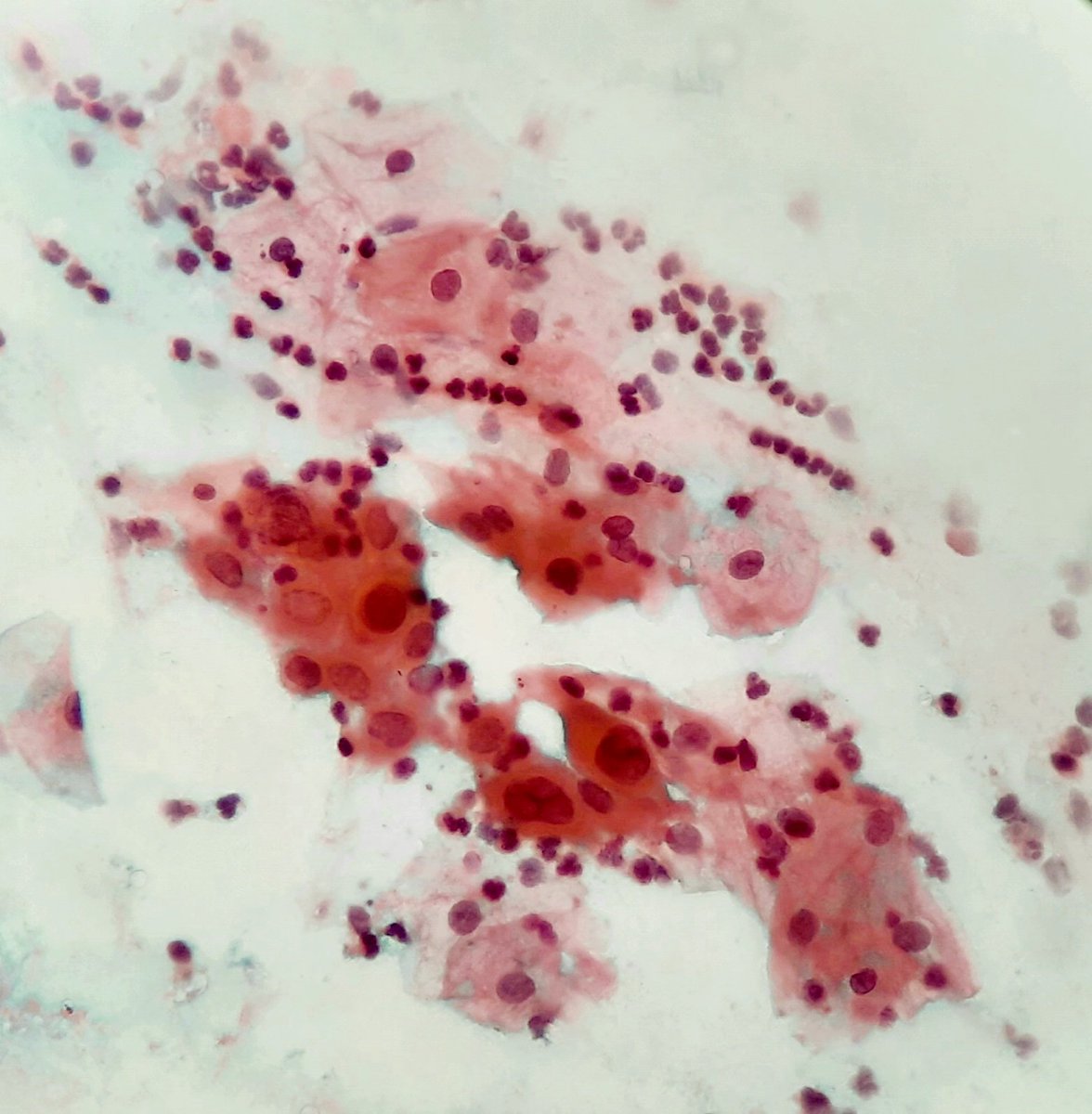 anitajawalgi's tweet photo. Sharing beautiful case of cervical pap smear. What is your diagnosis
Case borrowed from my colleague.
#PathTwitter #pathfinder #pathologists #pathlogy residents # #gynpath https://t.co/2XJYw9UmeC