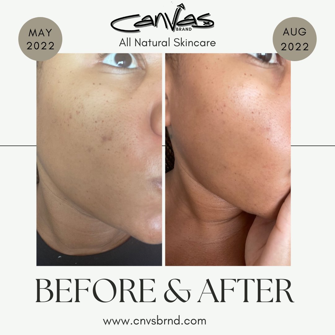 cnvs_wrld's tweet photo. Nothing like #RESULTS - Take 30% Off Today and start your journey to rid acne scars! 🤠🤎🤍 ⁠
⁠
Use Code: ILUVMYSLF at checkout 🛍️ #clicklinkinbio #skincareresults #hyperpigementation #skincaretips https://t.co/86IHExqANk