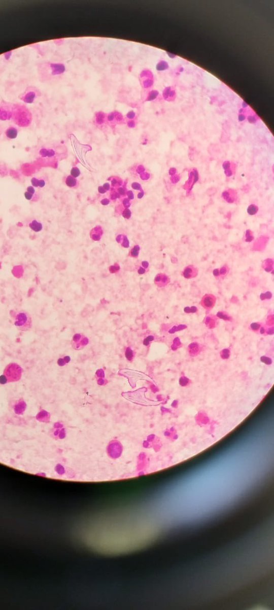ErumKhan23's tweet photo. Rare disease in western world but still a reality in Pakistan ! My lab just diagnosed echinococcus granulosus ! Scolex seen on smear! Excellent book picture ! https://t.co/Y4gPrHoBXg