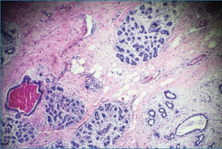 OncologyTimes's tweet photo. The Phase III TROPiCS-02 study found that the antibody-drug conjugate sacituzumab govitecan leads to #PFSbenefit over single-agent #chemotherapy in patients with pretreated HR+/HER2-, endocrine-resistant #metastatic breast cancer @UCSFCancer #bcsm #bcher: https://t.co/xtiWkCQAUP https://t.co/qcGmkmrB9V