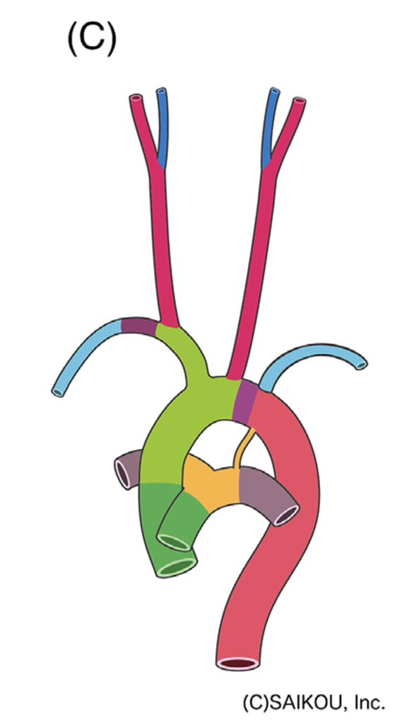 Mannino74's tweet photo. Functional Arterial Anatomy 🩸of the Brain🧠. Arterial development. Anomalies. Primitive Carotid Basilar  anastomoses. ICA. ACA. MCA. Vertebral arteries. Cerebellar arteries.
Great review for all #stroke physicians. 👩🏾‍⚕️🧑‍⚕️ 
👉🏿Stroke Vasc Interv Neurol. 2022;0:e000446 It’s 🆓! https://t.co/OIwHUIolcT